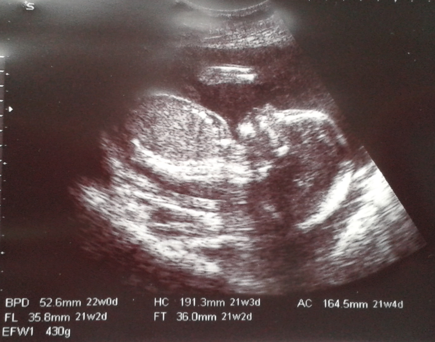 Ultrasound image of Elizabeth in utero.